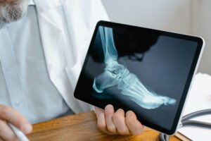 ankle fractures
